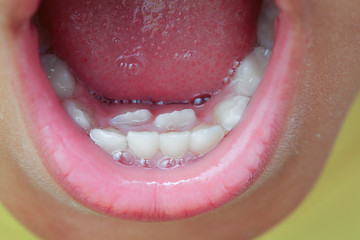 Closeup of double row teeth