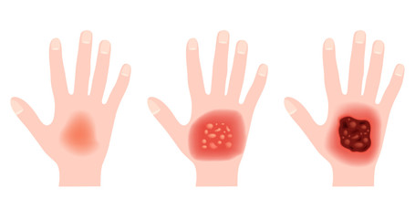step of burn . Normal to serious burn skin . vector and icon / hand
