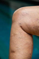 Varicose veins on knees and  legs in Senior women, Body concept