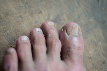 The problem of defects of the nails, which are the organs of the