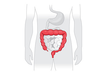 Illustration about abnormal symptom of human large Intestine. Disease about Digestive system.