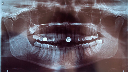 Man x-ray of the teeth wisdom teeth problem