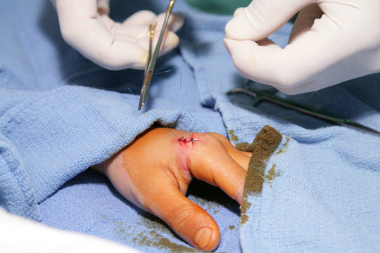 Injury - Stitches