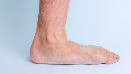 The left leg of a man with signs of joint disease and flat feet.