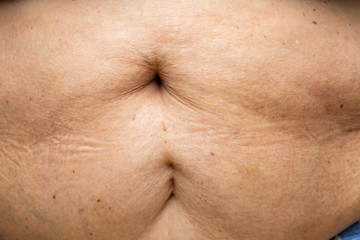 Fototapeta premium Senior women body fat belly front view, Sterilization scar, Black moles, Unhealthy concept