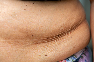 Senior women body fat belly front view, Black moles, Unhealthy concept