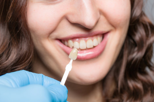 Farbe für einen Zahneratz am Mund einer Patientin aussuchen