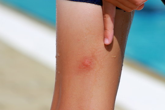 Mückenstich am Bein