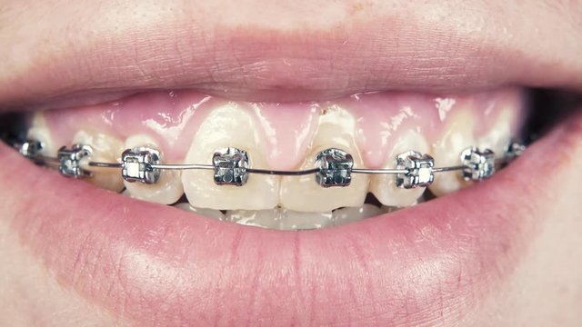 Metal braces on teen boy's teeth and smile close-up