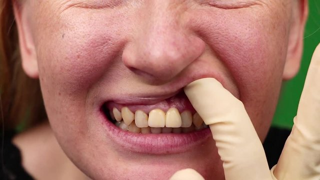 Macro video of yellow teeth. A close-up of a tooth, struck by caries. The concept of poor oral care. Rot, unpleasant odor, carious teeth. Close-up of the mouth