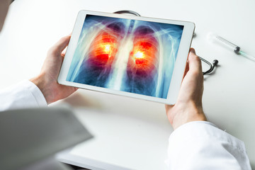 Doctor watching a xray of lung cancer on digital tablet. Radiology concept - Powered by Adobe