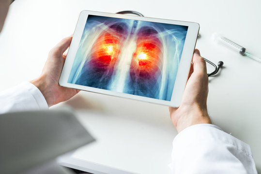 Doctor watching a xray of lung cancer on digital tablet. Radiology concept
