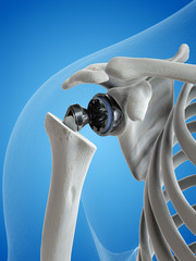 3d rendered medically accurate illustration of a shoulder replacement - obrazy, fototapety, plakaty