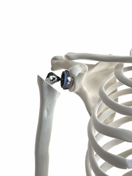 3d rendered medically accurate illustration of a shoulder replacement