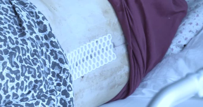 A young girl lies in a post-operative room on a hospital bed. It has a special honeycomb dress. Rests after spine surgery, scoliosis. 