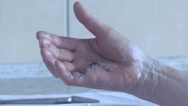 Nurse in the hospital treatment room, removes the bandages from the man's hand. Wound with blood in close-up , Dupuytren's contracture. Panning camera, Pan, Closeup