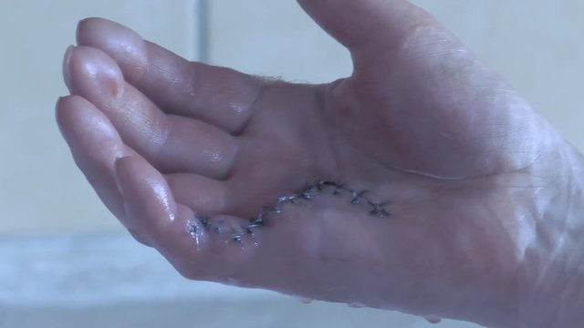 Nurse in the hospital treatment room, removes the bandages from the man's hand. Wound with blood in close-up , Dupuytren's contracture. Panning camera, Pan, Closeup