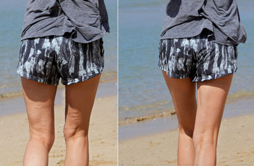 Female legs with and without cellulite, before and after anti cellulite treatment. - obrazy, fototapety, plakaty