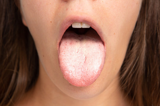 Macro of tongue with bacterial patina