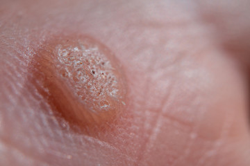 Verruca on hand. Warts or moles freeze concept