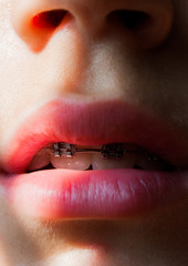 Fixed device on the teeth of a girl