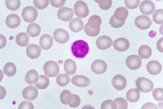 Lymphocyte cell in blood smear, analyze by microscope
