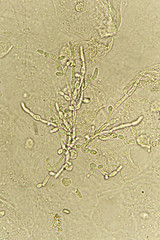 Pseudohyphae and budding yeast cells in patient urine 
