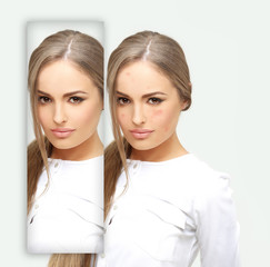 Acne.Post-Acne Marks /Treating Acne Scars