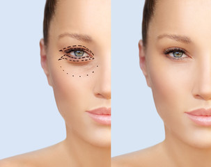Lower and upper  Blepharoplasty.Marking the face.Perforation lines on females face, plastic surgery...