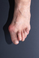 Fuß Hallux Valgus 