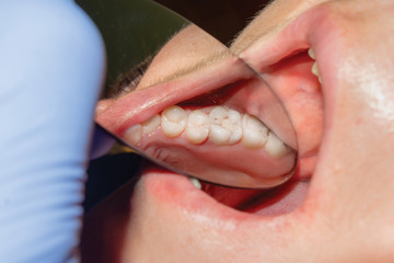human sick teeth close-up. Caries, fractured tooth root concept of dental treatment