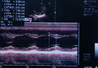 Color image of the ultrasound examination result. Made in an Ultrasound Machine. Human heart. Inter auricular communication (CIA) - obrazy, fototapety, plakaty