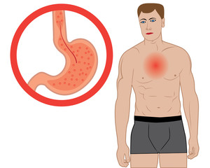 Gastroesophageal reflux desease. Gerd stomach in a human body vector illustration