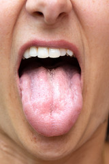Candidiasis on female tongue