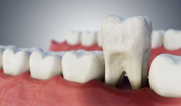 Infected tooth in mouth. 3D rendered illustration.