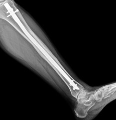 X-ray image of the anchorage of the shin bone