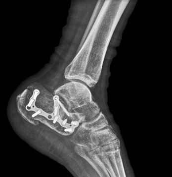 X-ray Of A Calcaneus Fracture Osteosynthesis