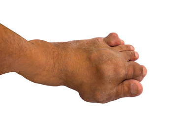 Painful gout inflammation or foot disease isolated on white background.