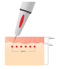 The scheme of the procedure of permanent makeup. - obrazy, fototapety, plakaty