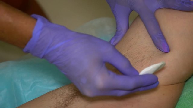 Beautician in Gloves Sterilizing Male Armpit before Sugaring Epilaion Procedure
