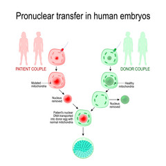 babies of three-parent. inherited mitochondrial diseases. Pronuclear transfer in human embryos.