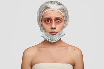 Plastic surgery and skin rejuvenation concept. Deprressed fearful woman patient with bruises around...