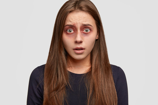 Life hurts me. Stunned emotional young Caucasian woman with bruised skin, being abused by violent husband, needs support, stands against white background, dressed in black sweater. Violence.