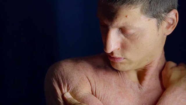 Adult man touching his unhealthy patched skin indoor, man with skin disease posing.