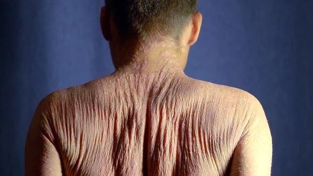 Man with problematic skin showing his back indoor, hronic psoriasis.
