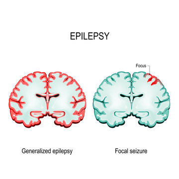  Primary Generalized Epilepsy And Focal Seizures