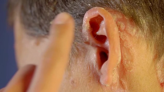 Close-up shot of a man with psoriasis on the head, rush skin behind the ear.