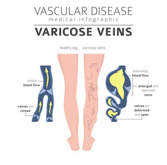 Vascular diseases. Varicose veins symptoms, treatment icon set. Medical infographic design