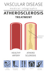 Vascular diseases. Atherosclerosis symptoms, treatment icon set. Medical infographic design