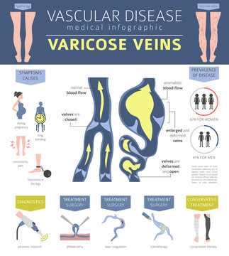 Vascular diseases. Varicose veins symptoms, treatment icon set. Medical infographic design